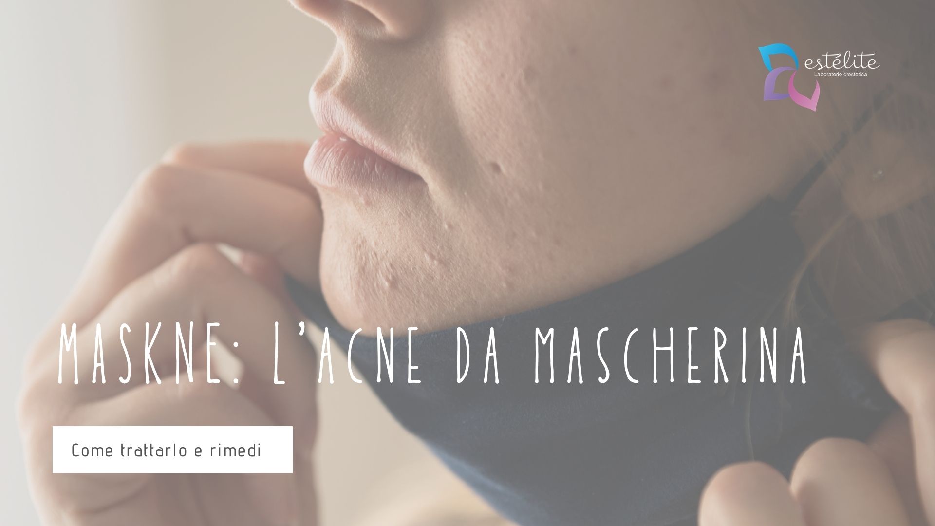 MASKNE acne rimedi mascherina